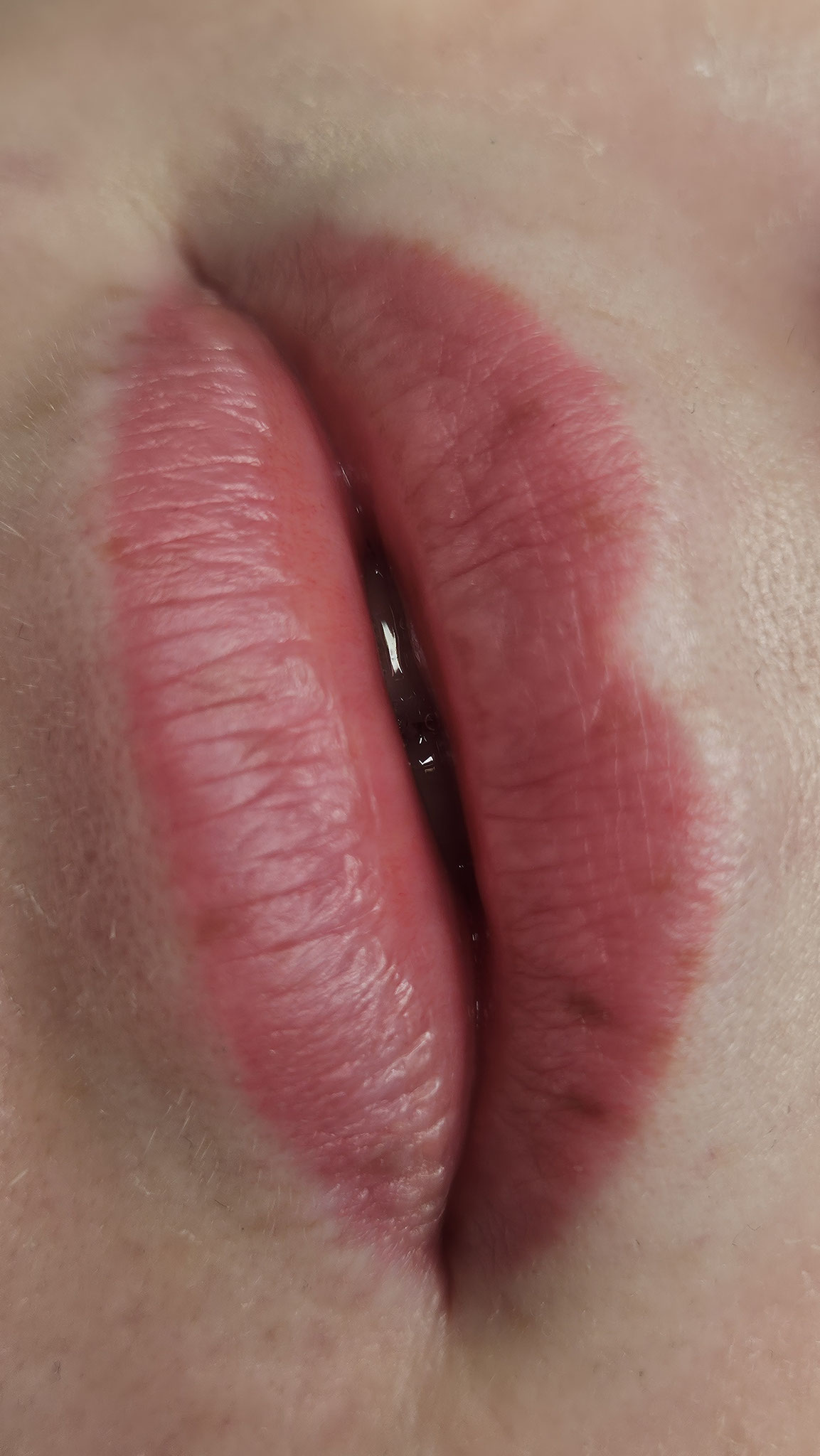 Lippen nach der Ruhephase von 5 Wochen