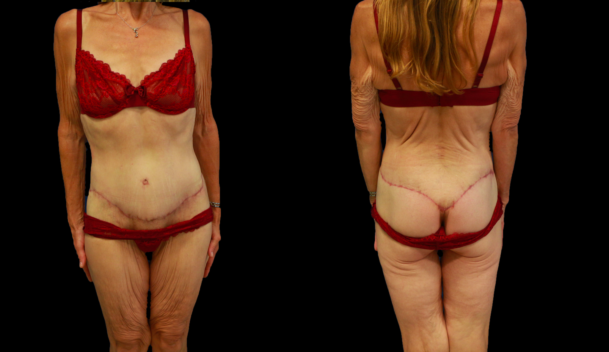 Cicatrices rouges à 3 mois  / Dr Vivien Moris