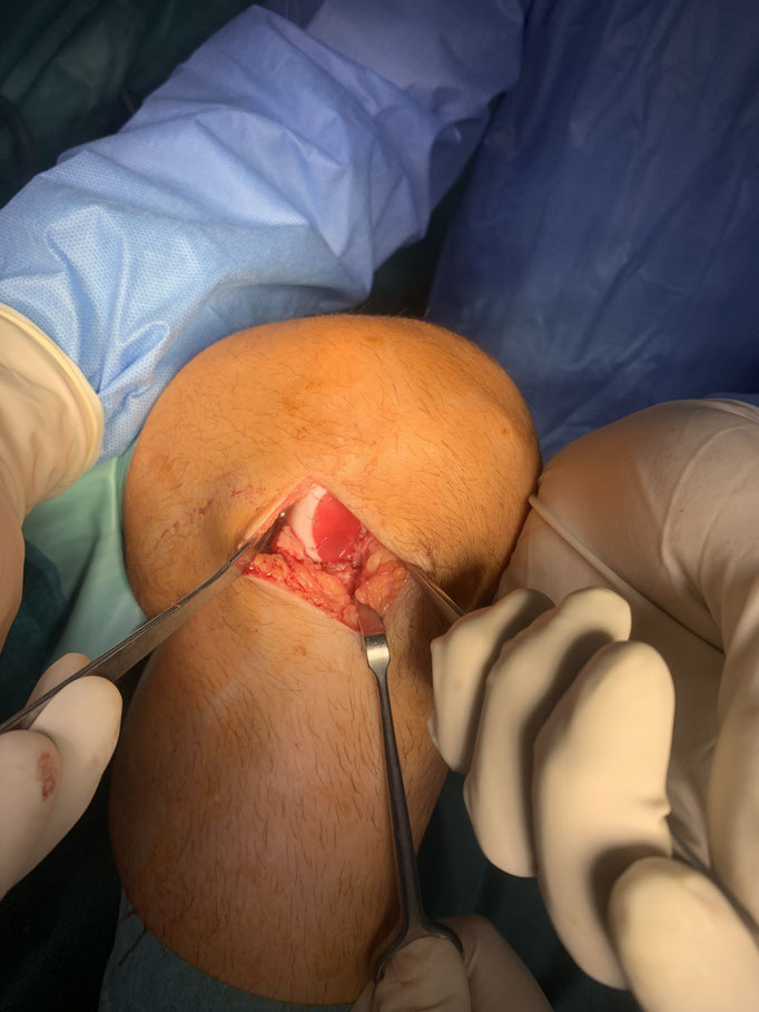 Das Bild zeigt das Endergebnis nach Einnähen des Knorpeltransplantats finden Defekt