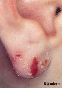 eczema sur boucle d oreille chez une femme noire