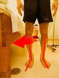 O脚とトゥーアウトのランナーの写真
