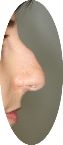 Example of a long hump nose