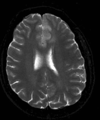 Diffuse astrocytoma T2