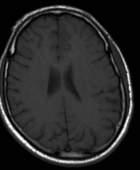 Diffuse astrocytoma T1