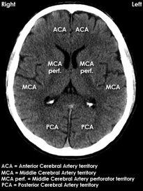 Vascular territories of the brain, Anterior Cerebral Artery, Middle Cerebral Artery, Posterior Cerebral Artery, Vertebro-Basilar Artery