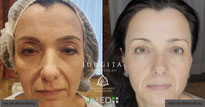 anti-aging, anti-aging behandlung euskirchen, ipl light touch, jugendliches hautbild, hautbehandlung, kosmetik