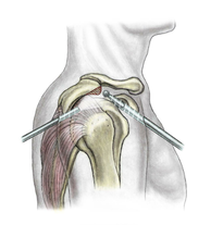 Arthroskopie Acromion