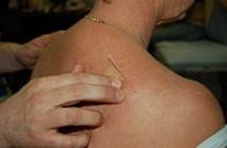 Dry needling Den Haag Vlierboomstraat