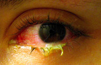 puss from bacterial conjunctivitis - photo via Tanalai at English Wikipedia