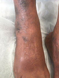 Eczéma violet foncé sur peau noire au niveau du pied