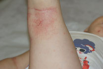 photo eczema pli du genou
