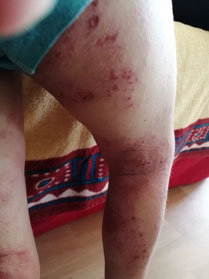 photo eczema surinfecte