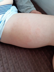 photo de eczema de l'enfant
