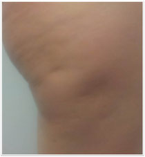 Unser Ergebnis nach der Behandlung der Cellulite mit Radiofrequenz