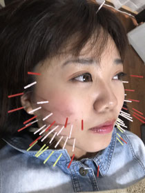小牧 鍼灸 はり 治療 腰痛 坐骨神経痛 肩こり 首こり 自律神経 頭痛 めまい
