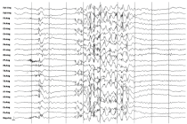 Bild: Aufzeichnungen eines EEGs