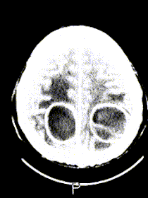 脳膿瘍の画像