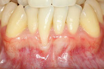 歯並びと歯周病
