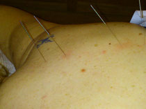 Acupuntura Madrid