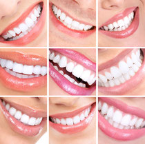 Mit Veneers bleiben Zähne dauerhaft schön und weiß. (© Kurhan - Fotolia.com)