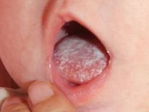 candidiasis en las uñas candidiasis en las uñas