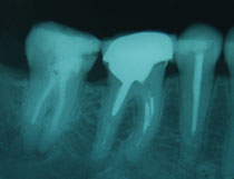 Endodoncias con necesidad de retratamiento