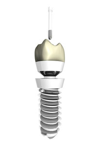 Sog. zweiteiliges Implantat mit aufgeschraubter Krone (© Marcus Kretschmar - Fotolia.com)