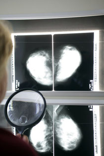Röntgenbild Mammographie mit 4 Einzelaufnahmen der Brust