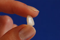 Veneer: ermöglichen schnell und sicher bestimmte Zahnkorrekturen. (© Mihail Cos - Fotolia.com)
