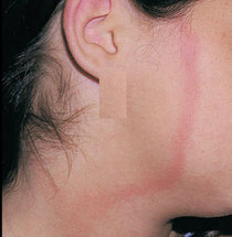 Erythema migrans Borreliose Homöopathie