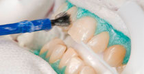 Auftragen des Bleaching-Gels in Weiden (© Foto: Initiative pro Dente e.V.)