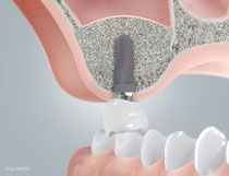 3. ausreichend Raum für ein Implantat