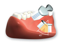 Borsten mit ca. 45 Grad Richtung Zahnfleisch ansetzen (© proDente e.V.)