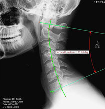 Cervical Lordosis
