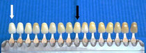 Bleaching beim Zahnarzt: Objektiv messbare Ergebnisse mit der Farbskala