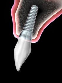 Schneidezahn-Implantat mit aufgesetzter Krone