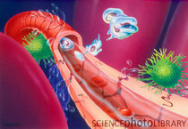 Caption: Septic shock. Artwork of a cutaway blood vessel during septic shock