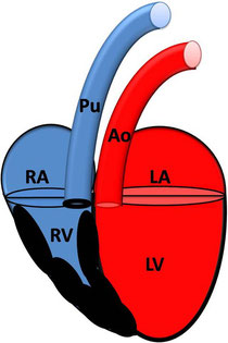 Valvuläre Pulmonalstenose mit Hypertrophie des rechten Ventrikel; RA: rechtes Atrium; RV: rechter Ventrikel; Pu: Pulmonalarterie; LA: linkes Atrium; LV: linker Ventrikel; AO: Aorta