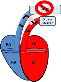 Verhältnisse beim Ungeborenen; RA: rechtes Atrium; RV: rechter Ventrikel; Pu: Pulmonalarterie; LA: linkes Atrium; LV: linker Ventrikel; Ao: Aorta