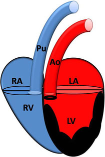 Subaortenstenose mit Hypertrophie des linken Ventrikel; RA: rechtes Atrium; RV: rechter Ventrikel ; Pu: Pulmonalarterie; LA: linkes Atrium; LV: linker Ventrikel; AO: Aorta