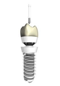 Sog. zweiteiliges Implantat mit aufgeschraubter Krone