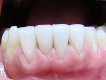 Veneers der unteren vier Schneidezähne (Aufnahme 4 Jahre nach dem Einsetzen): Das Zahnfleisch ist hell rosa und gesund. (© Doc S)