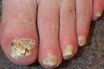 Onicomicosis