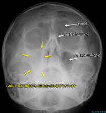 右の上顎洞炎です
