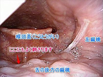 魚の骨が刺さった 熊本 くまモンファン 耳鼻咽喉科医の みみ はな のど あれこれ 魚の骨が刺さった 熊本 くまモンファン 耳鼻咽喉科医の みみ はな のど あれこれ