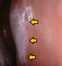 鼻中隔右側の粘膜を硝酸銀で焼いたところです