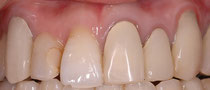 歯茎の再生治療