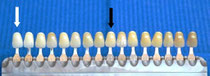 Mit einer Farbskala kann der Zahnarzt die Wirkung der Zahnaufhellung exakt messen