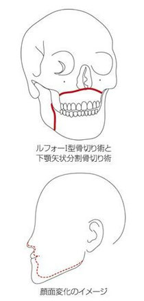究極の小顔形成術 美容整形sos 美容整形を受ける前に 美容整形のトラブル相談 究極の小顔形成術 美容整形sos 美容整形を受ける前に 美容整形のトラブル相談