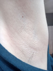 4回脱毛して２週間たった状態です。生命力がある部分が少し残ってますが後少しですね(^o^)